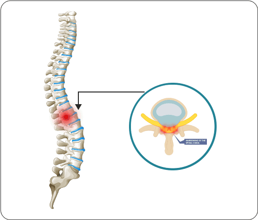 Spinal stenosis - causes, symptoms and treatment