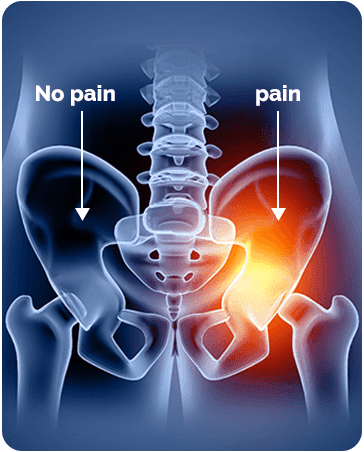 Pelvic Girdle Pain Treatment, Symptoms & Causes | ANSSI