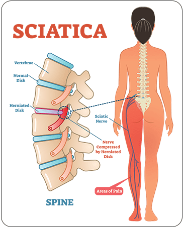 Sciatica Treatment, Symptoms & Causes