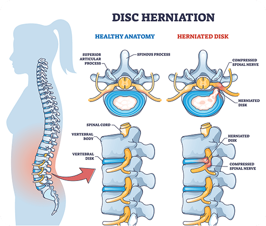 Herniated Disc - Symptoms and Causes