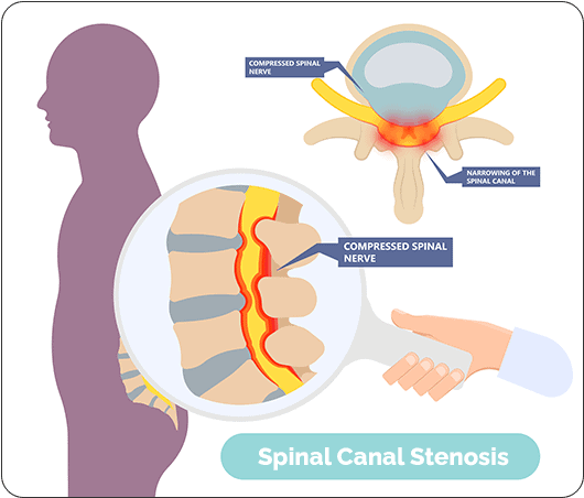 What Causes Spinal Stenosis?