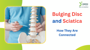 Back pain is one of the most common health concerns worldwide, and two conditions that are often linked are bulging discs and sciatica.