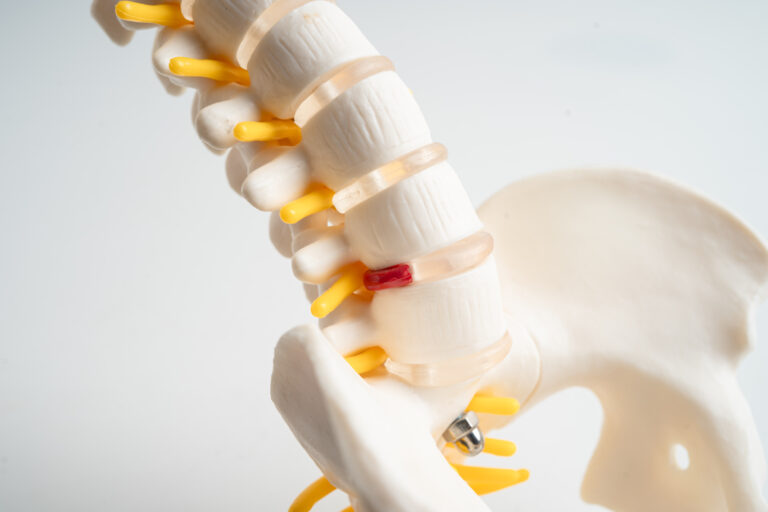 A slipped disc can gradually compress nearby spinal nerves, leading to pain that becomes more intense and difficult to manage over time.