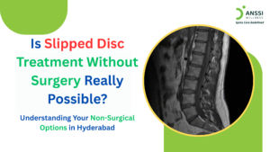 A slipped disc, also known as a herniated or bulging disc, occurs when the soft inner portion of a spinal disc pushes outward through its outer layer.