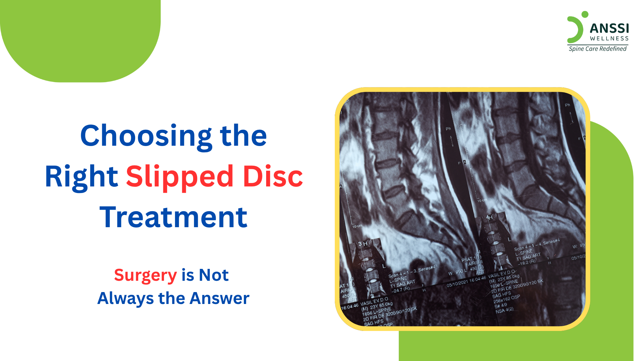 Slipped Disc? Surgery Is Not Always Needed