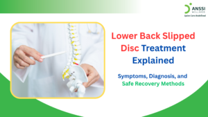 A slipped disc occurs when the soft inner portion of a spinal disc pushes through its outer layer, putting pressure on nearby nerves.