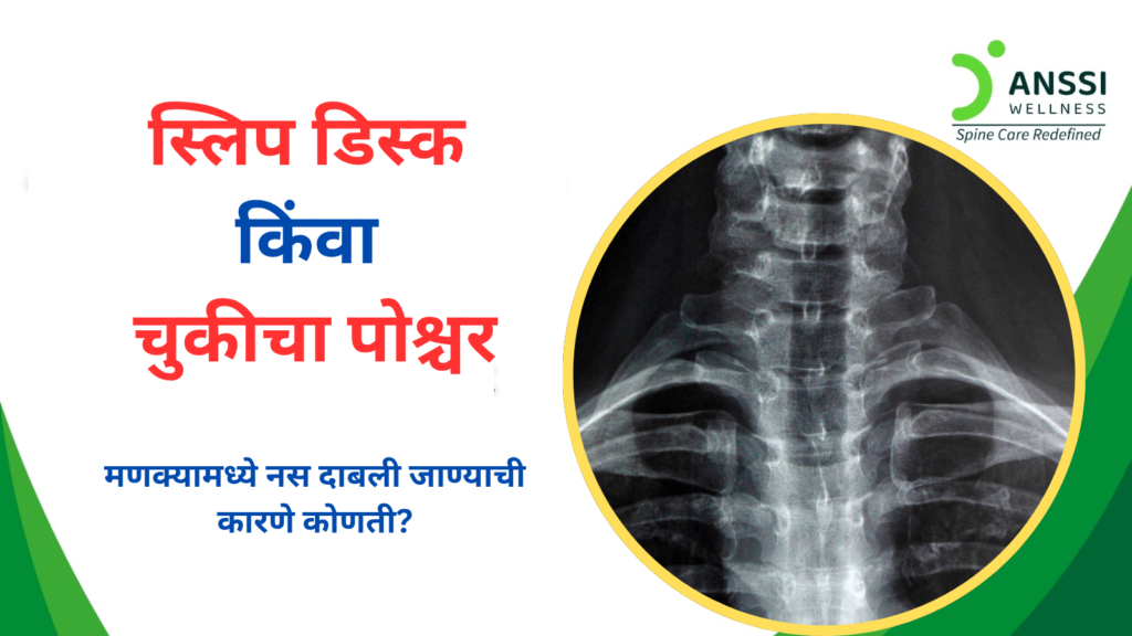 नस दाबली जाणे म्हणजे शरीरातील एखाद्या नसेवर (nerve) आसपासच्या ऊतींचा (जसे की स्पाइनल डिस्क, हाड किंवा स्नायू) दाब येणे.