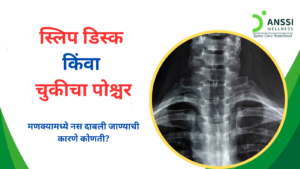 नस दाबली जाणे म्हणजे शरीरातील एखाद्या नसेवर (nerve) आसपासच्या ऊतींचा (जसे की स्पाइनल डिस्क, हाड किंवा स्नायू) दाब येणे.