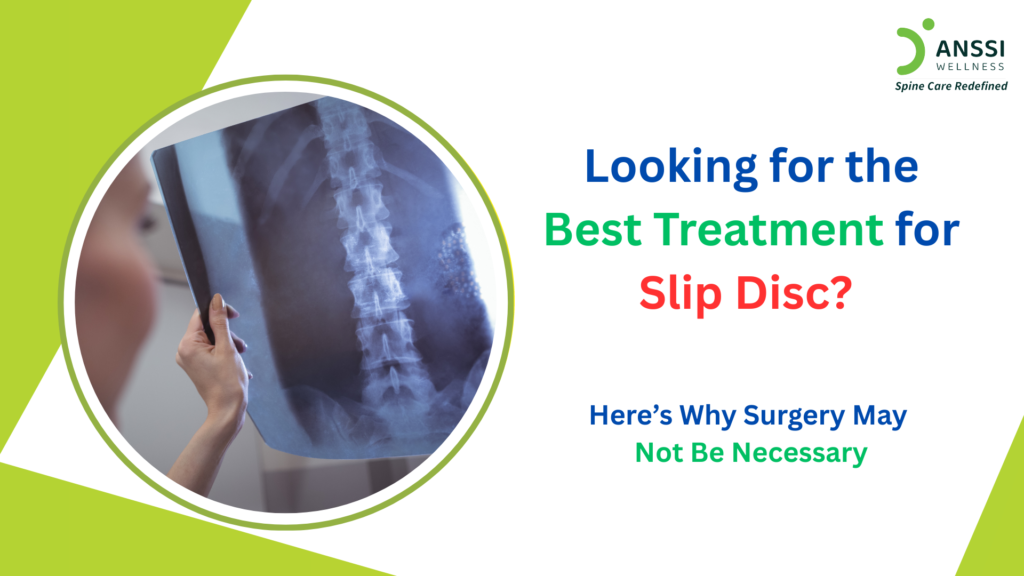 A slip disc, also known as a herniated or prolapsed disc, occurs when the soft inner portion of a spinal disc pushes through its outer layer.
