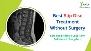 Many mild-to-moderate slipped disc cases can be effectively managed through conservative and advanced non-surgical treatment approaches.