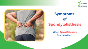 The severity of spondylolisthesis symptoms often corresponds to the degree of vertebral displacement and nerve involvement.