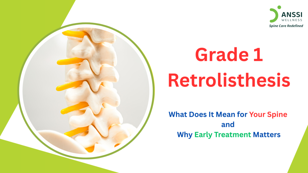 Retrolisthesis refers to the posterior displacement of one vertebra relative to the vertebra below it. It is a backward slip, as distinct from spondylolisthesis, in which displacement is forward.
