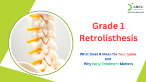 Retrolisthesis refers to the posterior displacement of one vertebra relative to the vertebra below it. It is a backward slip, as distinct from spondylolisthesis, in which displacement is forward.